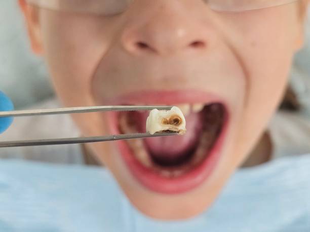 Best Emergency Tooth Extraction in Haiku Pauwela, HI